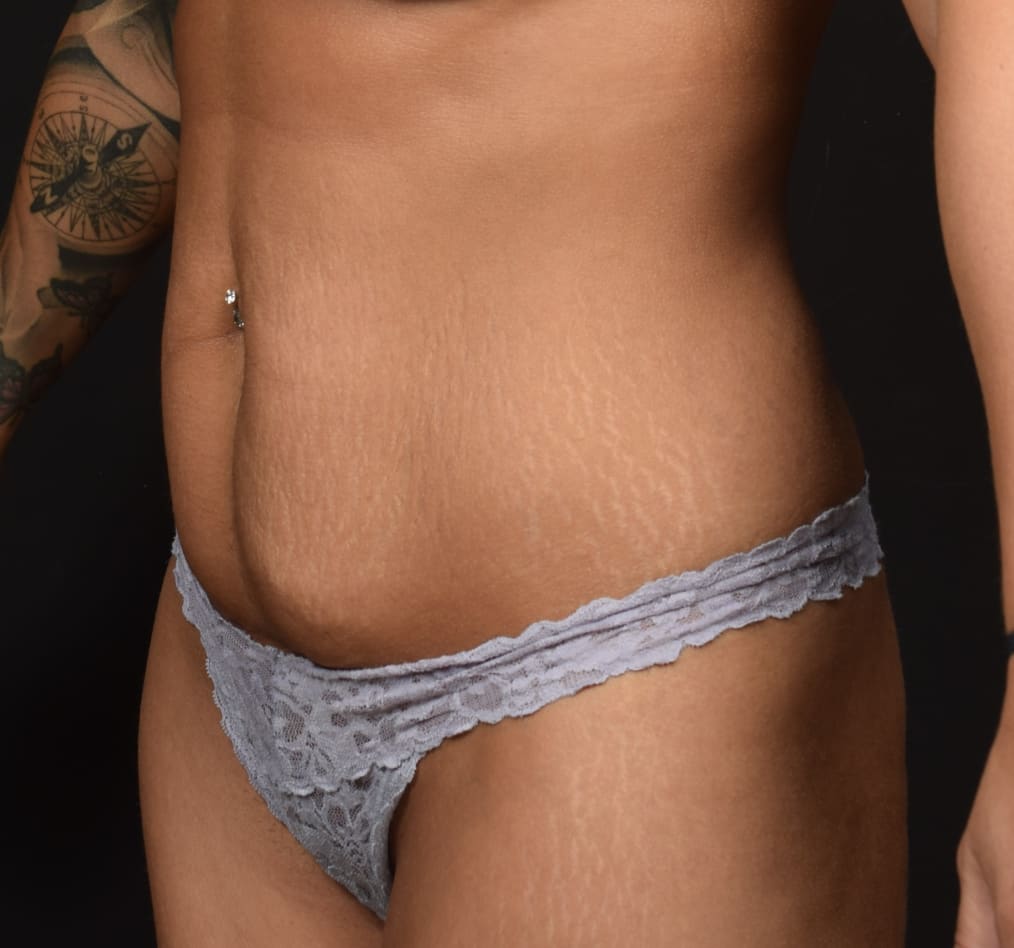 Patient 57 gallery before b