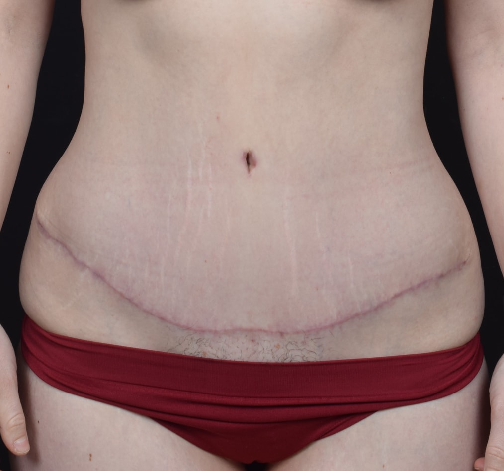 Patient 58 gallery after a