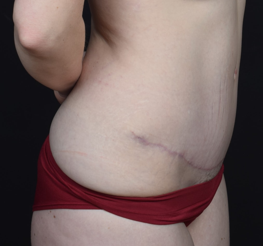 Patient 58 gallery after c