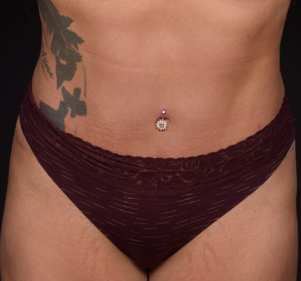 Patient 59 gallery after a