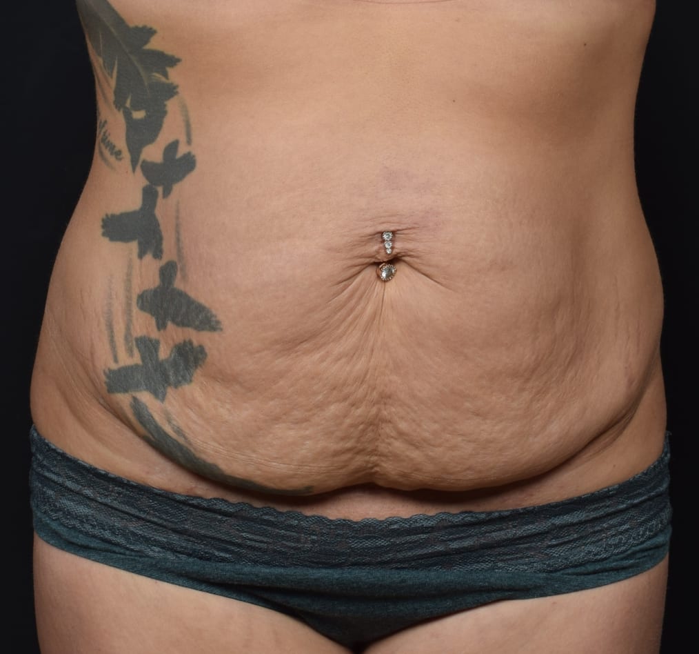 Patient 59 gallery before a