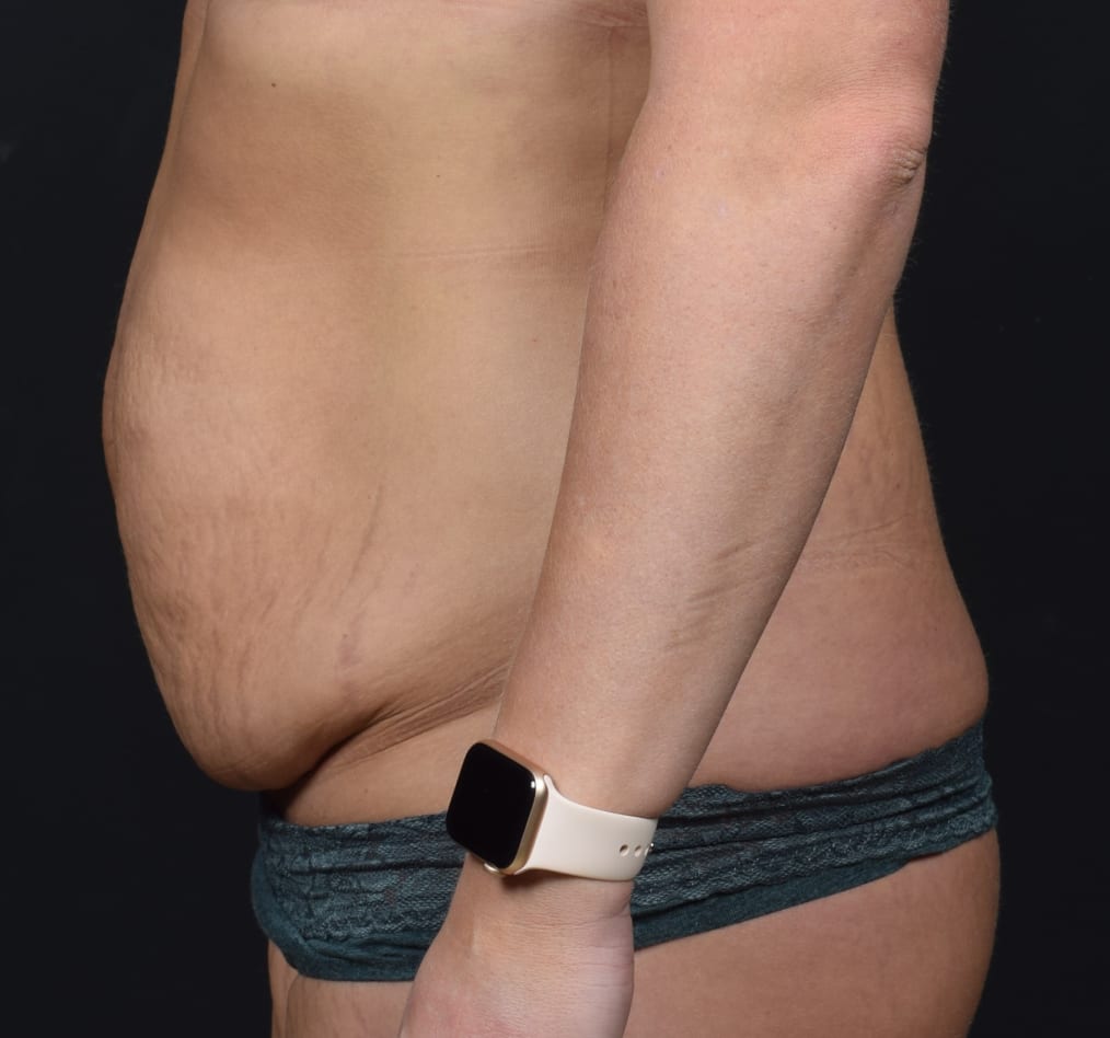 Patient 59 gallery before d