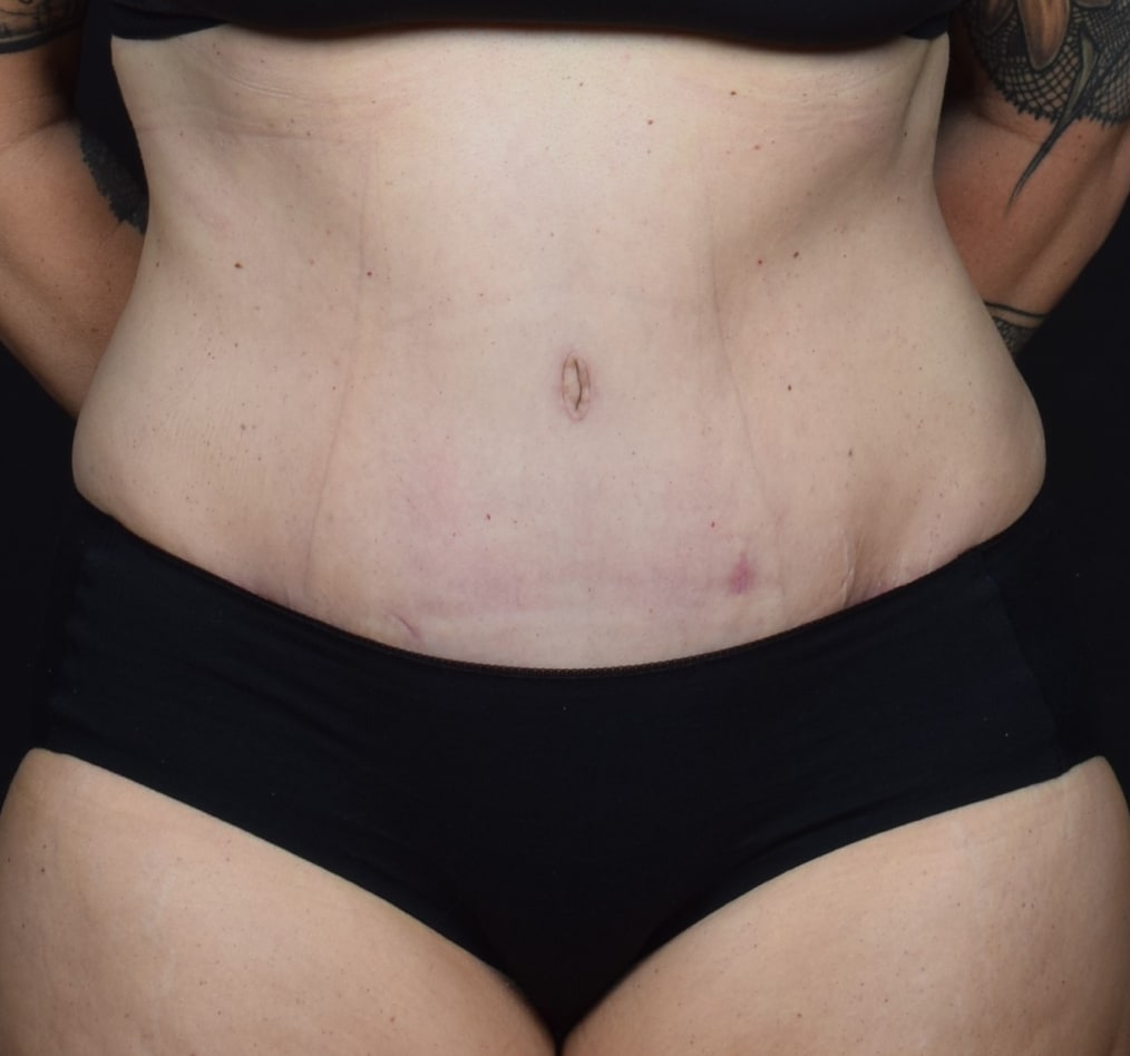 Patient 60 gallery after a