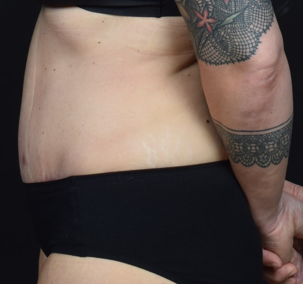 Patient 60 gallery after d