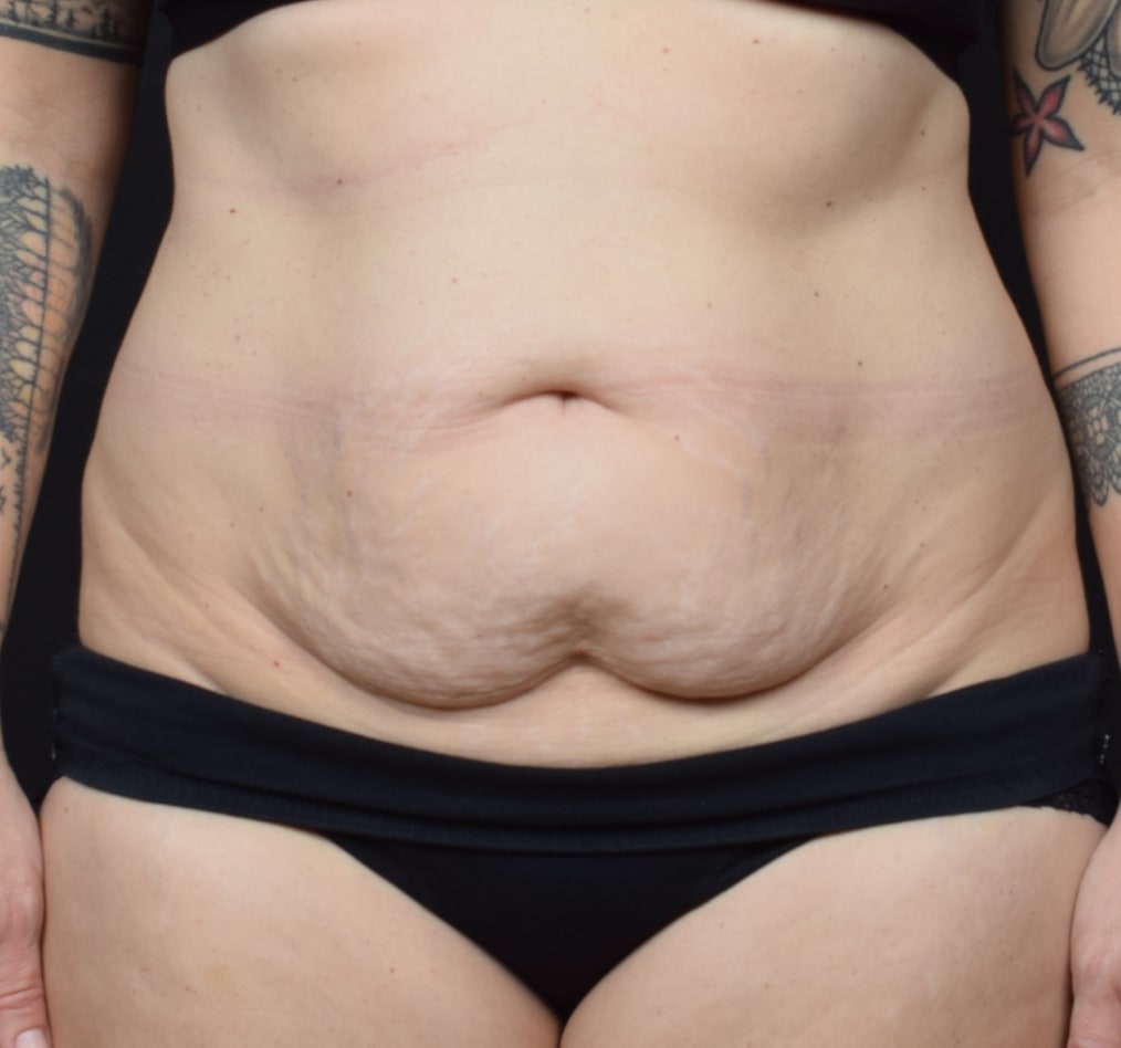 Patient 60 gallery before a