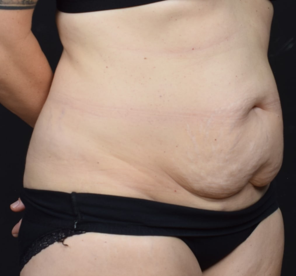 Patient 60 gallery before c