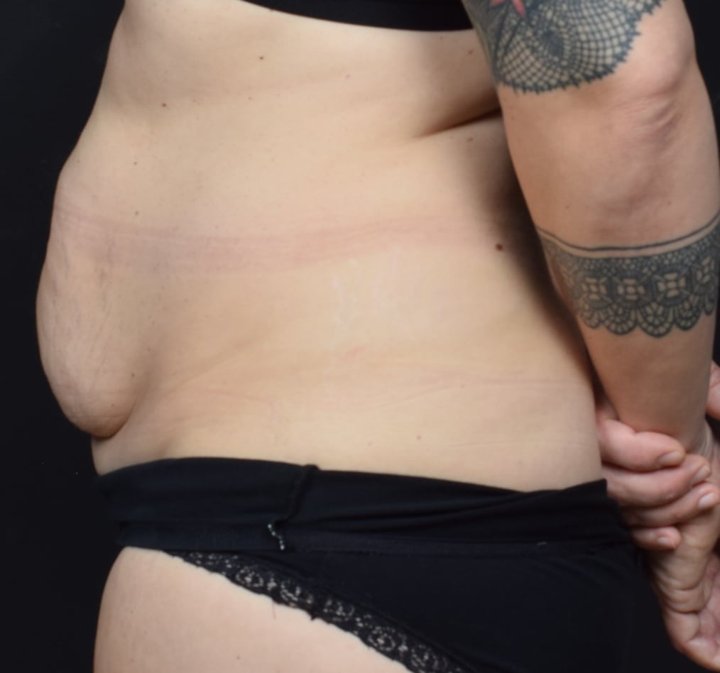 Patient 60 gallery before d