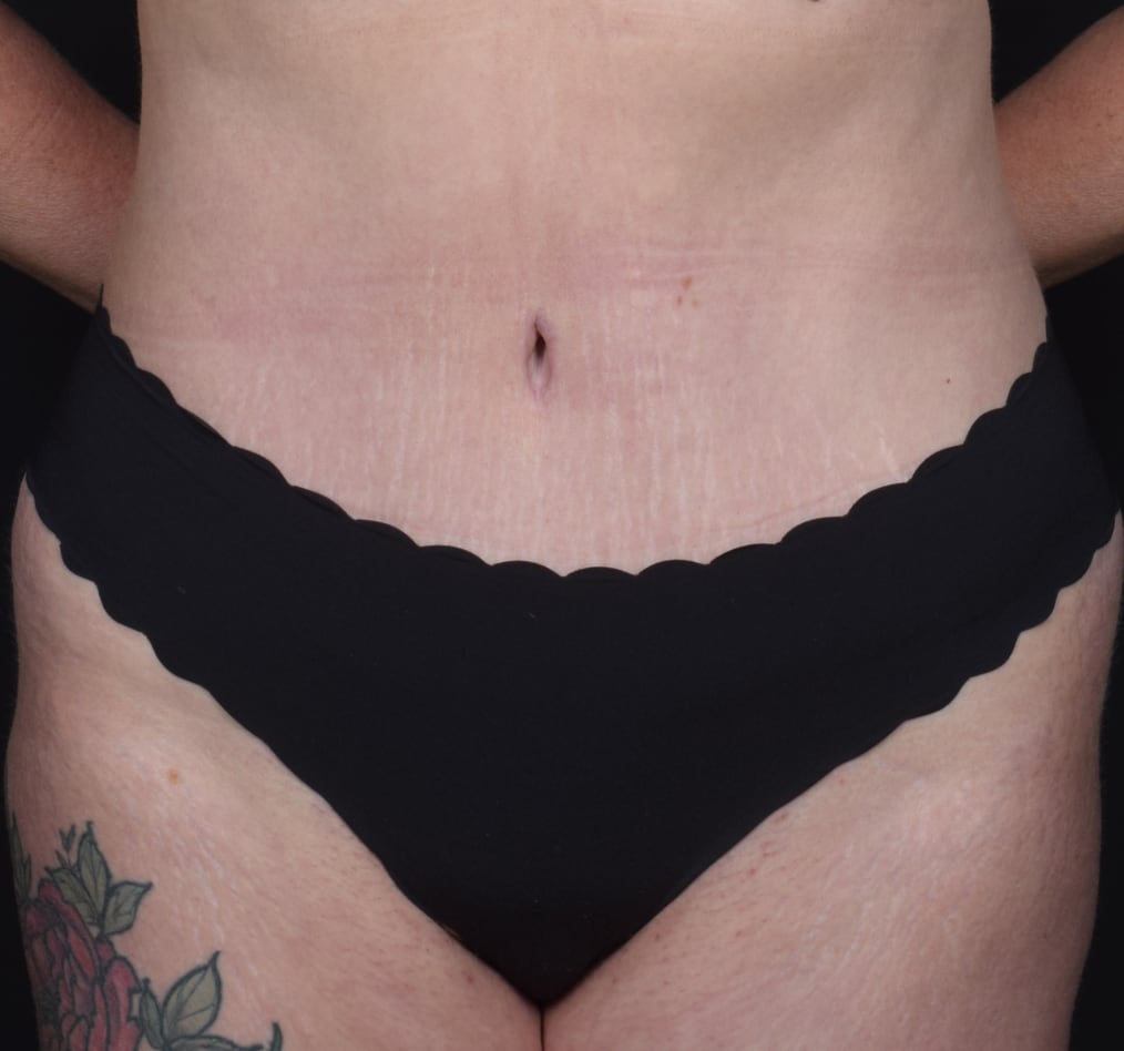 Patient 61 gallery after a