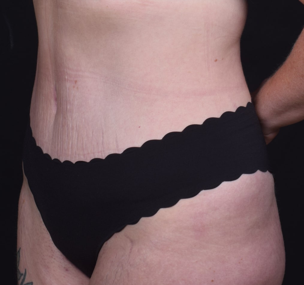 Patient 61 gallery after b