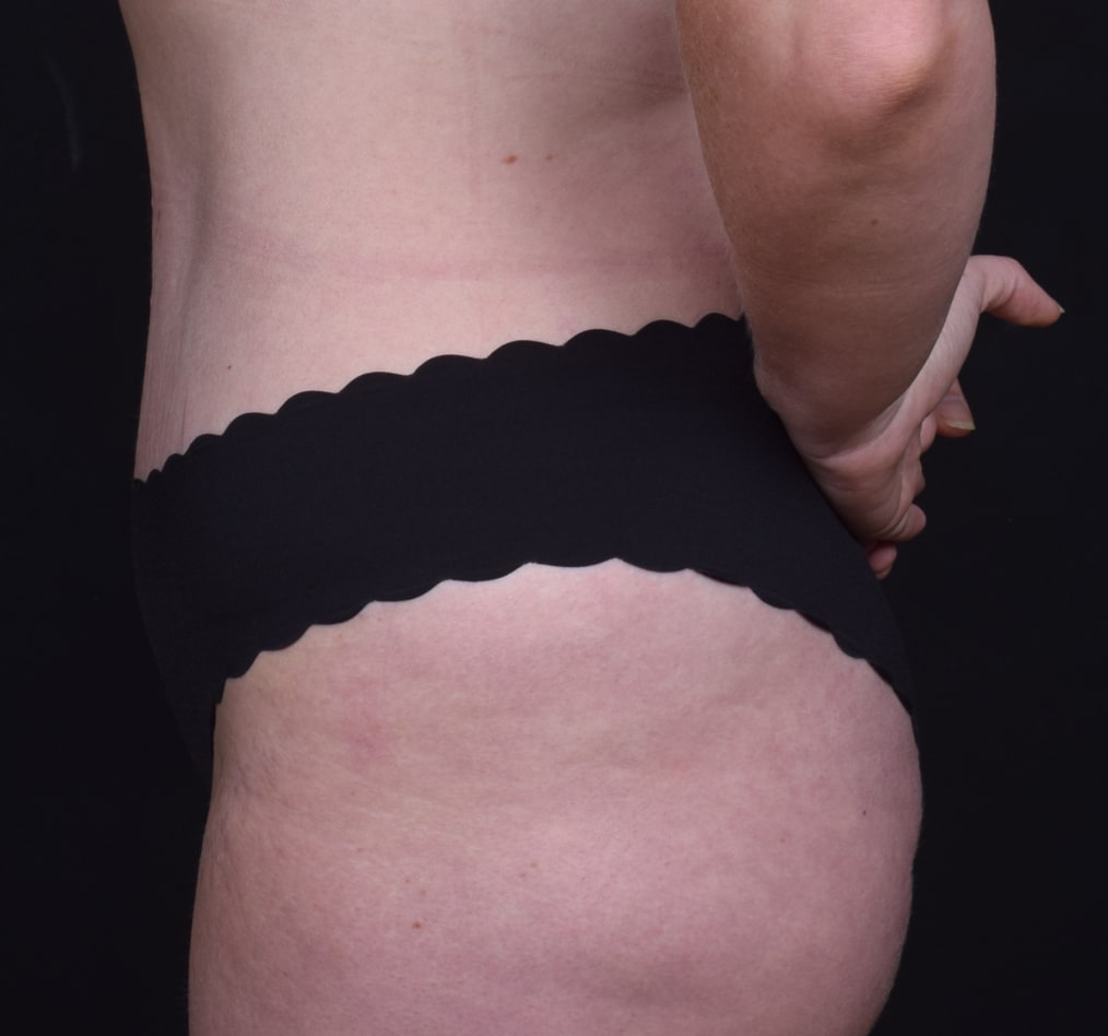 Patient 61 gallery after d