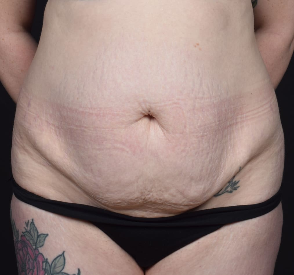 Patient 61 gallery before a