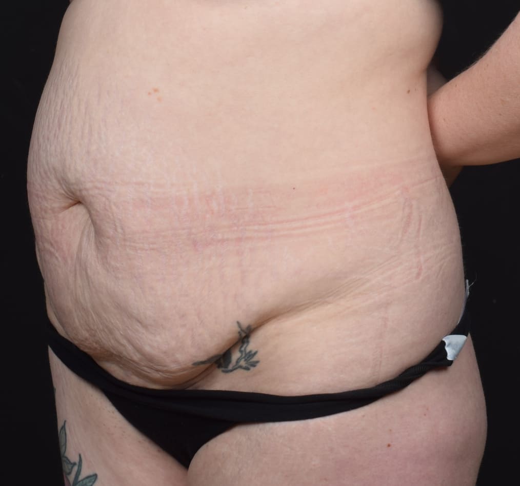 Patient 61 gallery before b