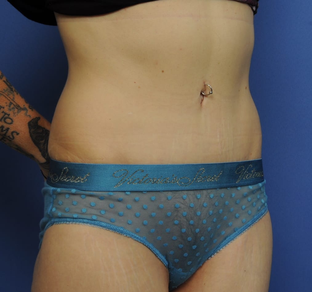 Patient 62 gallery after c