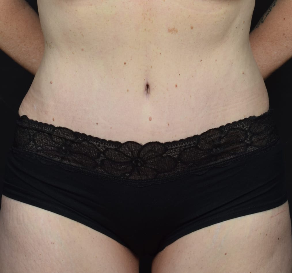 Patient 64 gallery after a