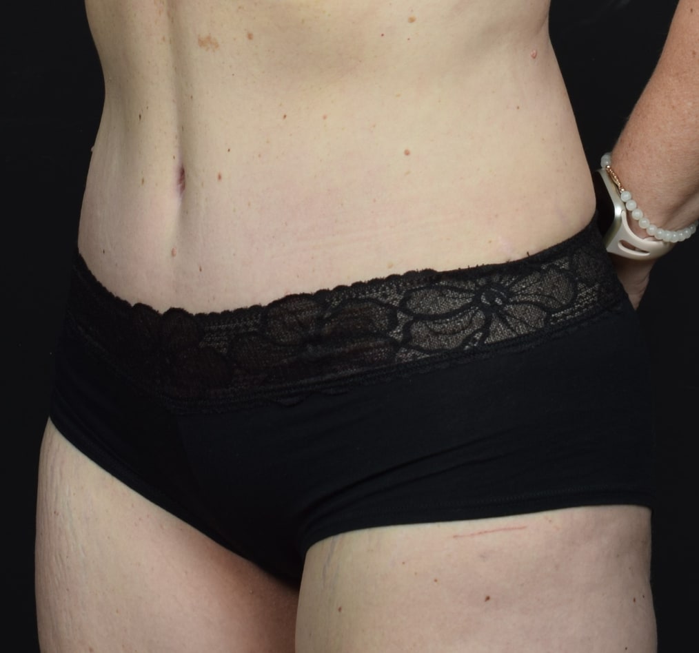 Patient 64 gallery after b