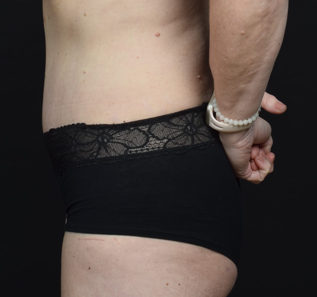 Patient 64 gallery after d