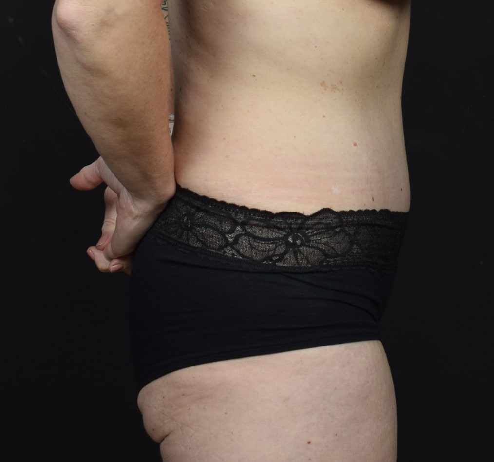 Patient 64 gallery after e