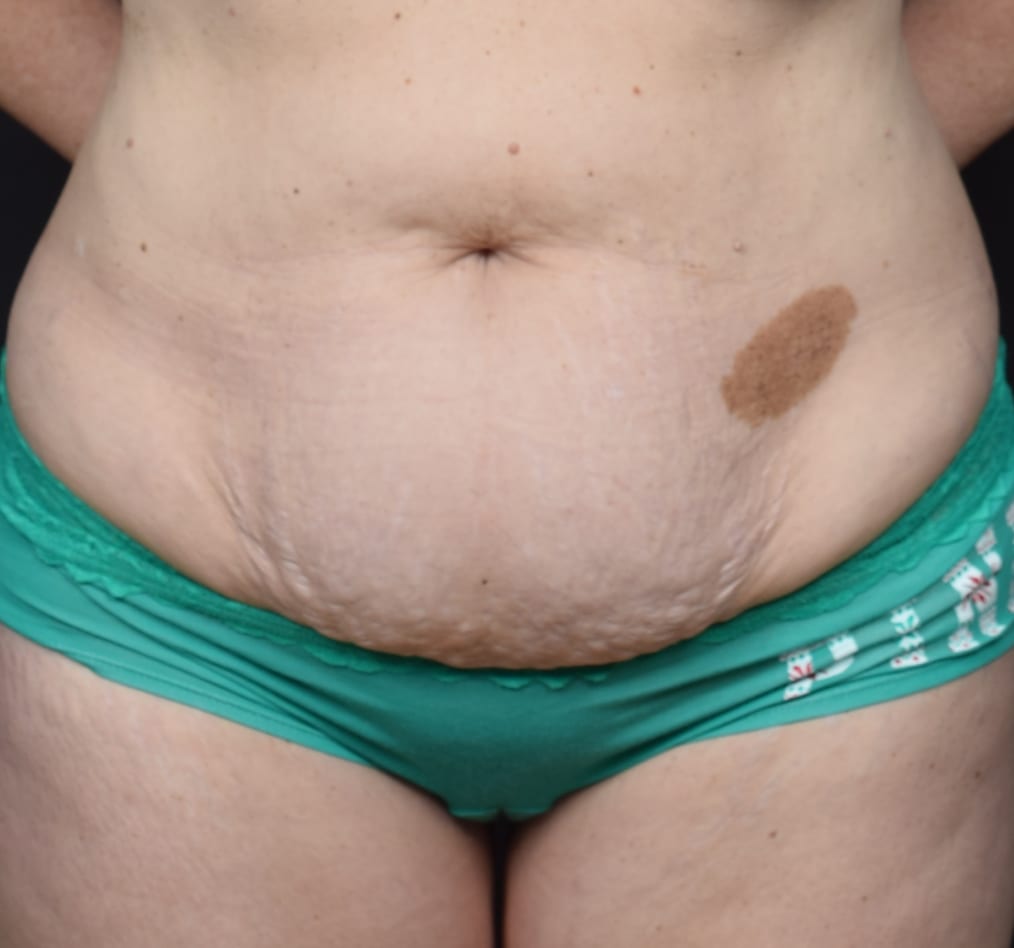 Patient 64 gallery before a