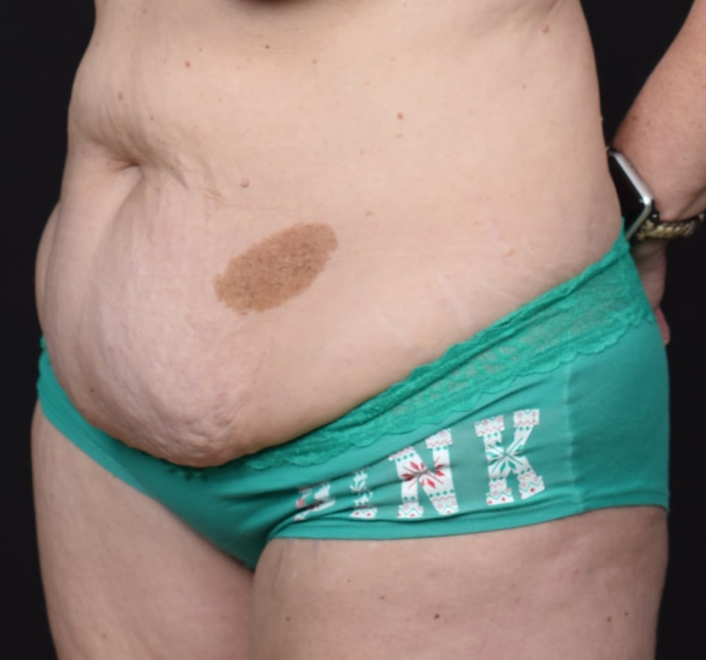 Patient 64 gallery before b