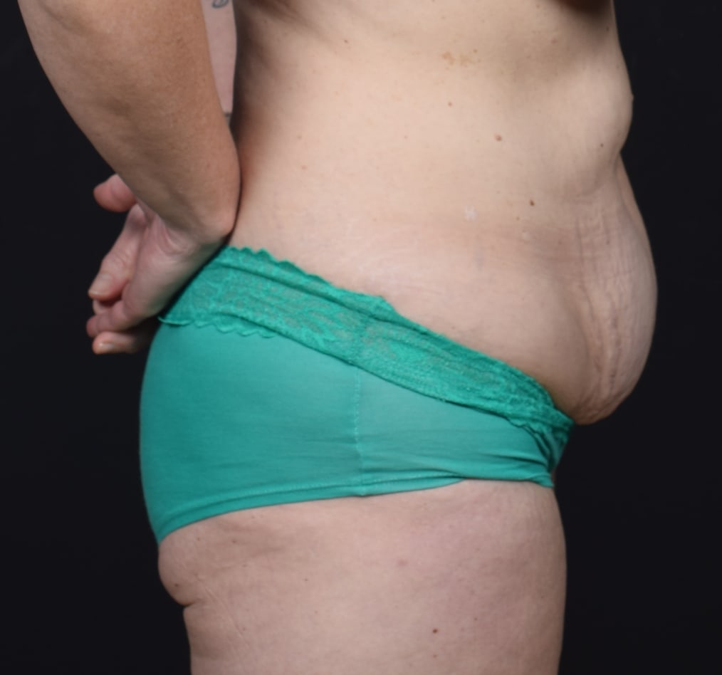 Patient 64 gallery before e