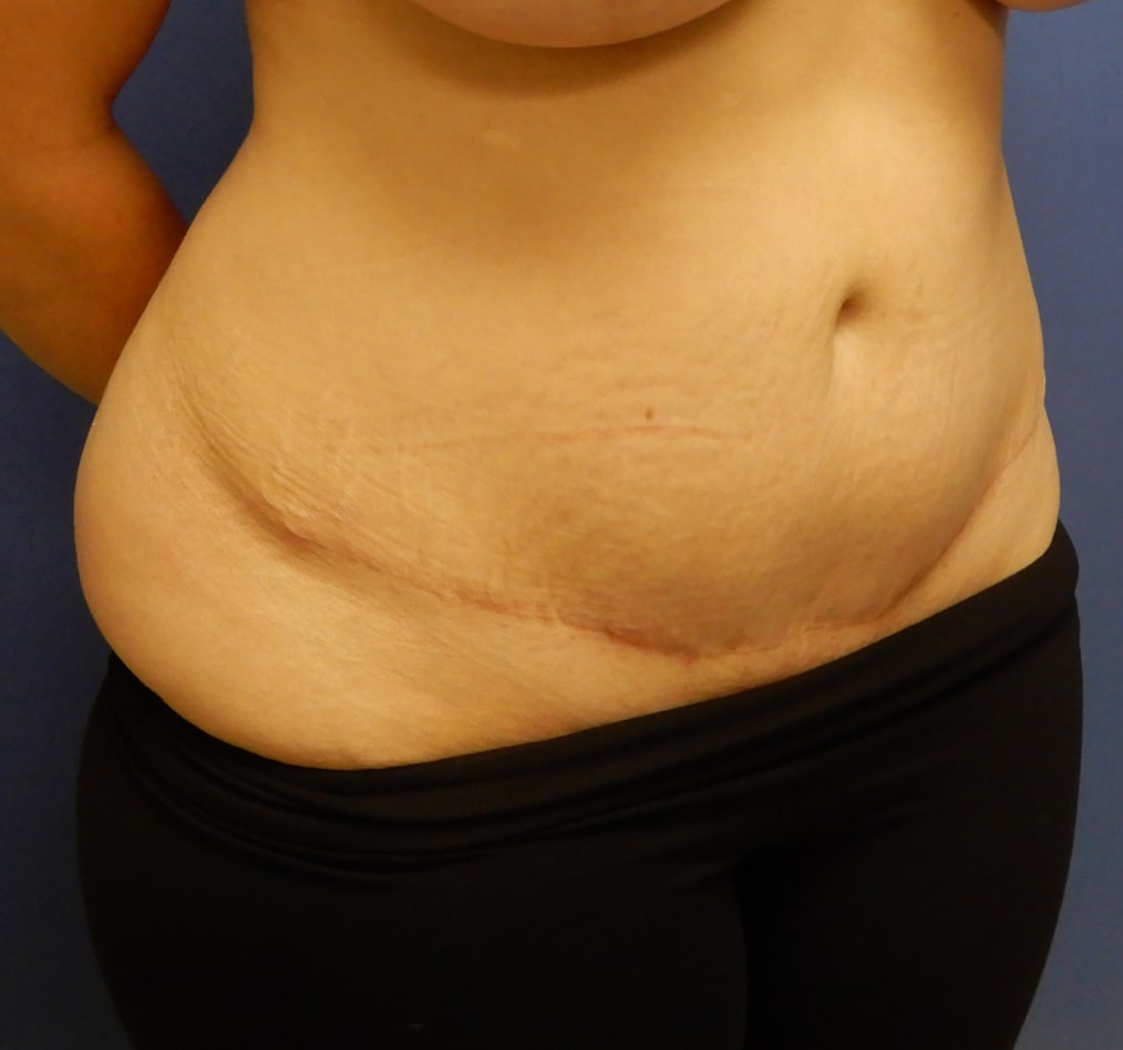 Patient 65 gallery after c