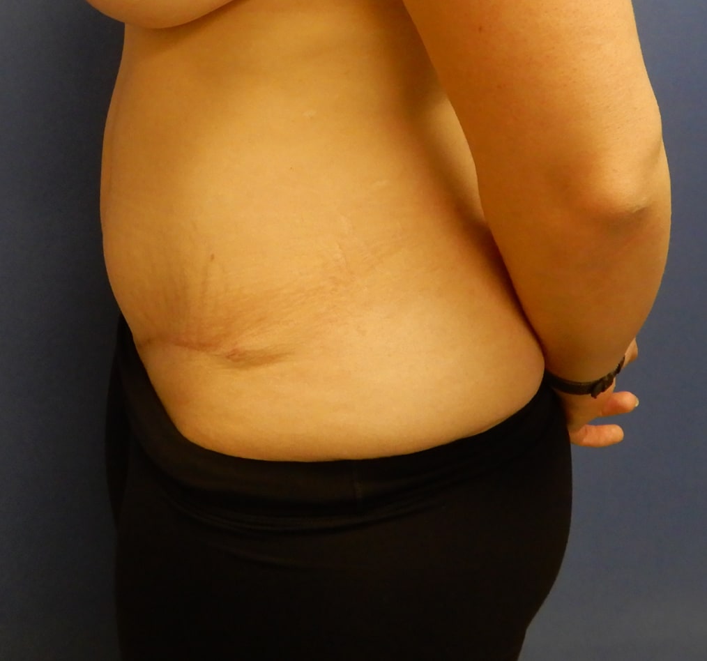 Patient 65 gallery after d