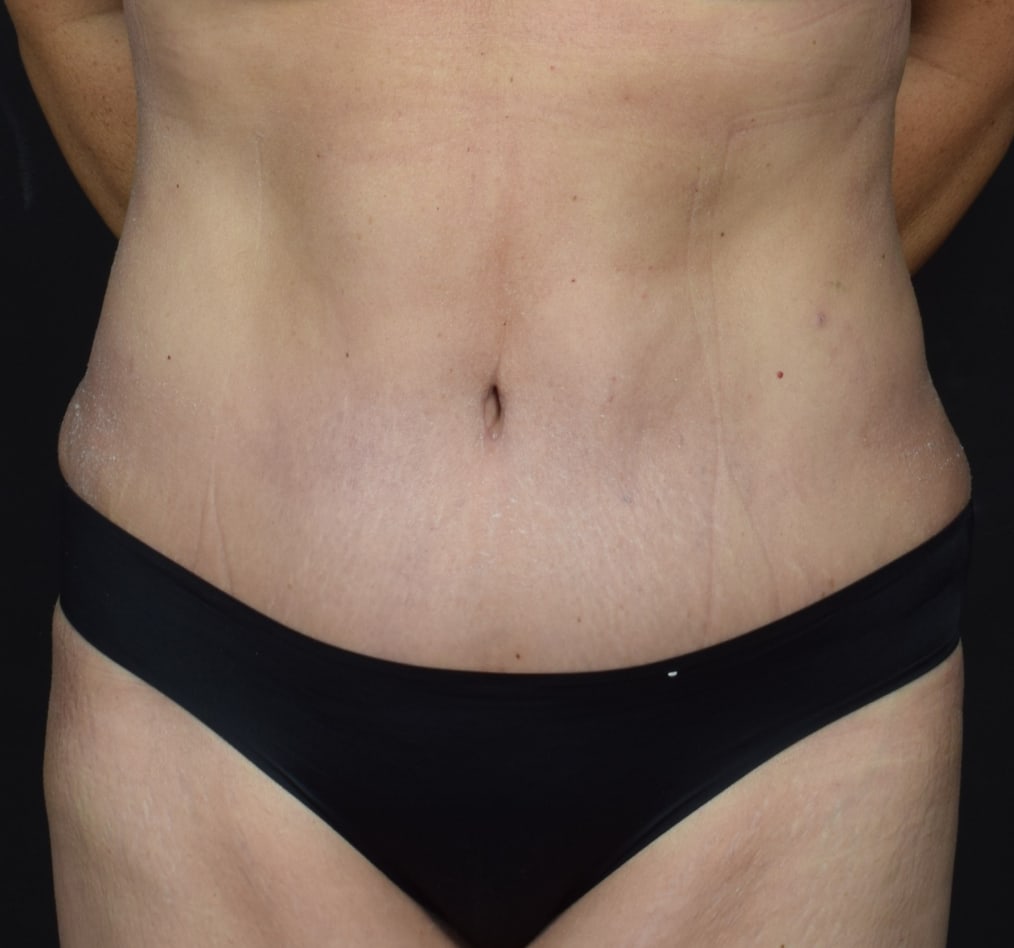 Patient 66 gallery after a