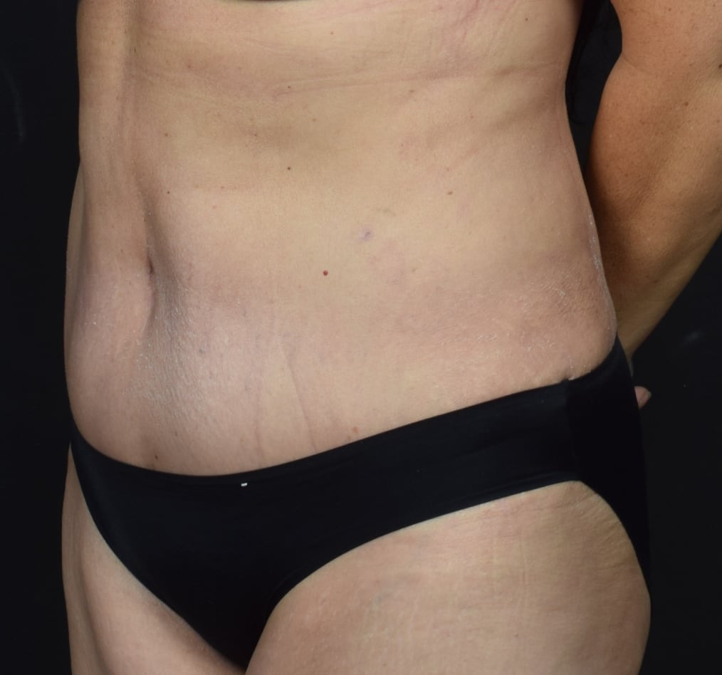 Patient 66 gallery after b