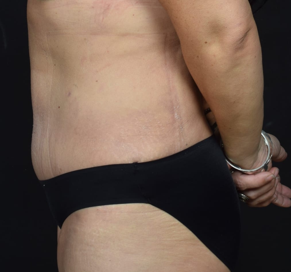 Patient 66 gallery after d