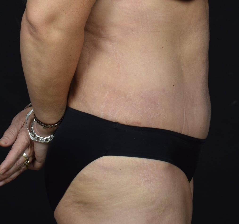 Patient 66 gallery after e