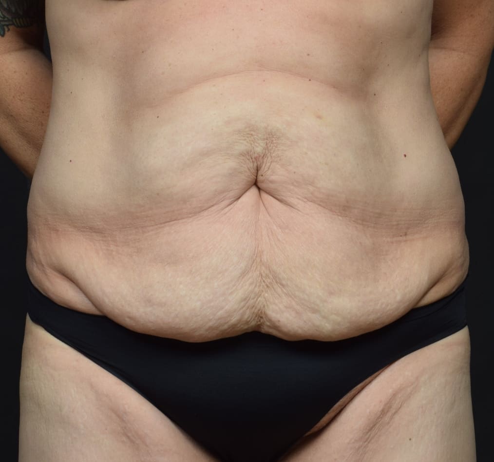 Patient 66 gallery before a