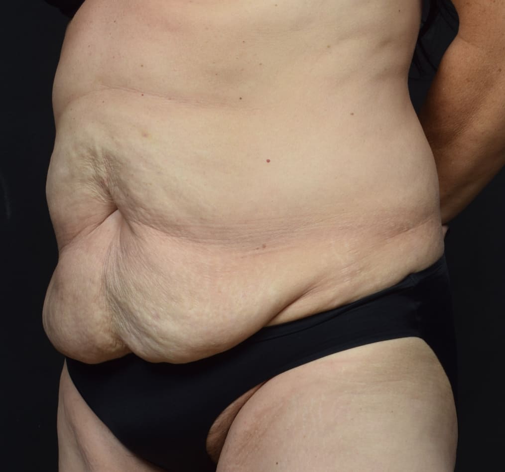 Patient 66 gallery before b