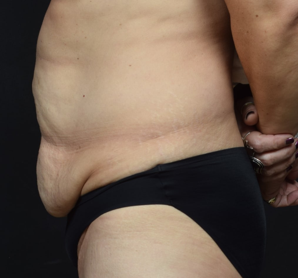 Patient 66 gallery before d