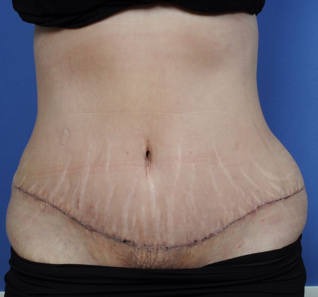 Patient 67 gallery after a