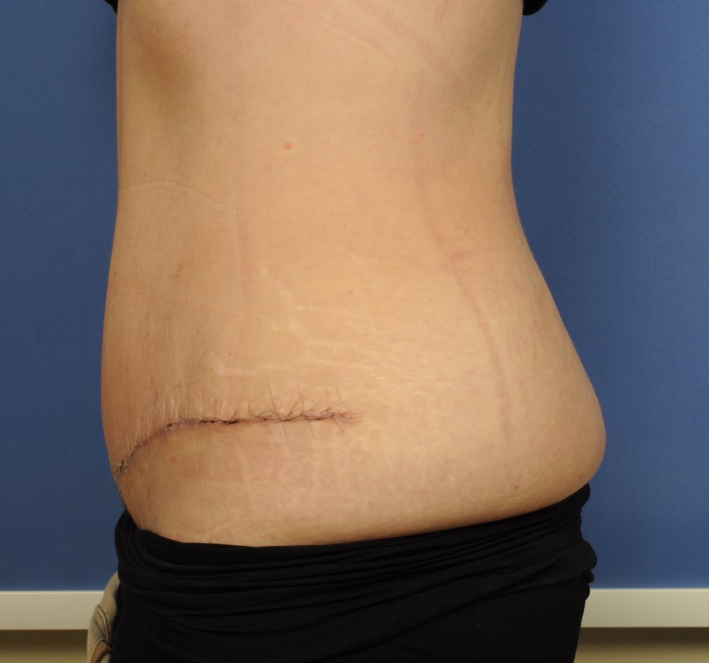 Patient 67 gallery after d