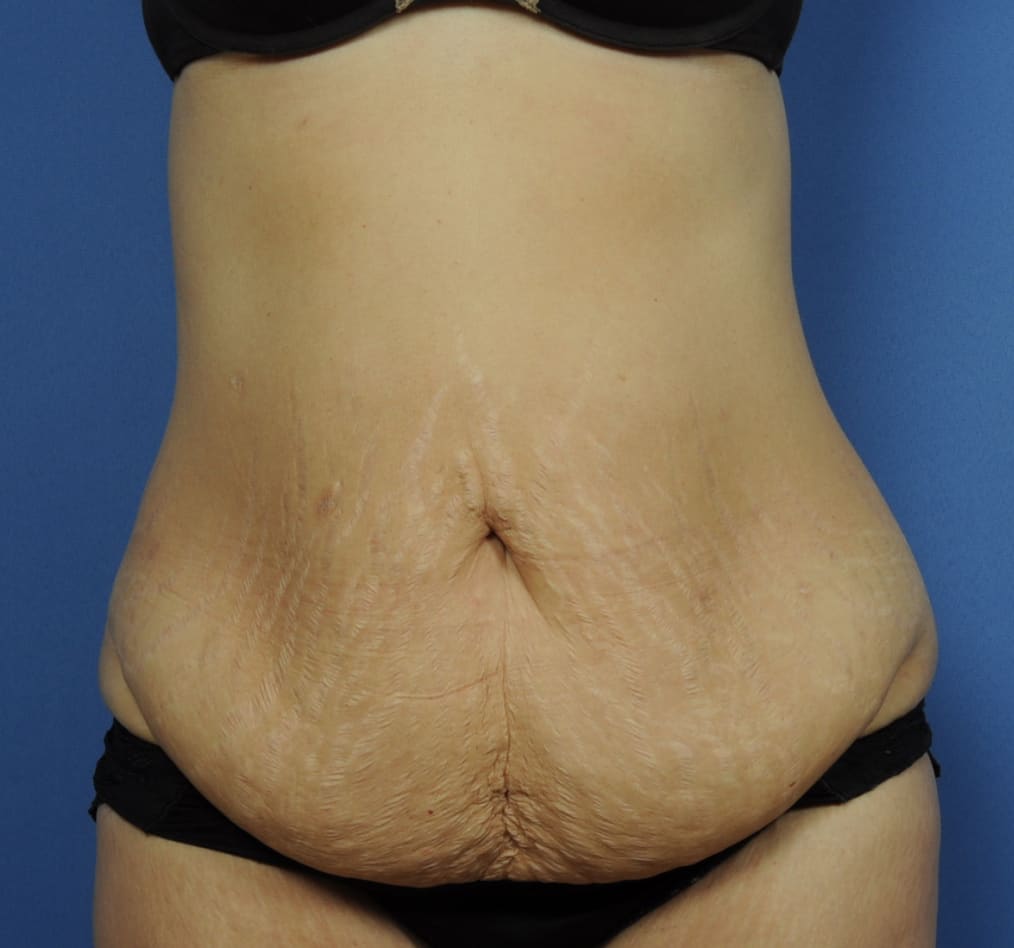 Patient 67 gallery before a