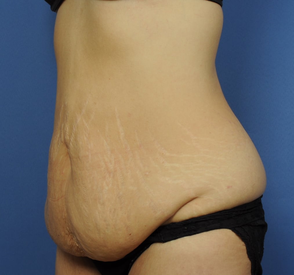 Patient 67 gallery before b