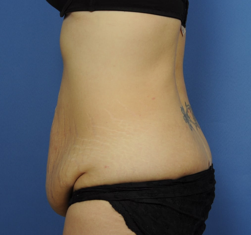 Patient 67 gallery before d