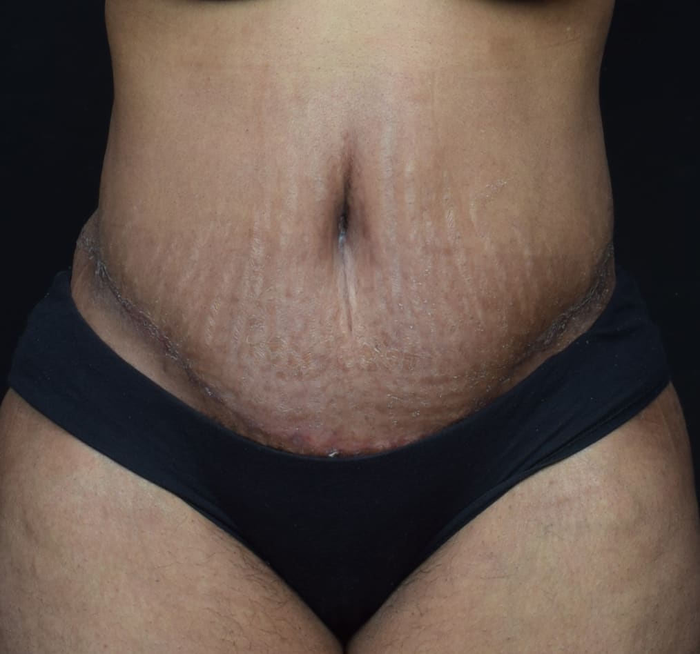 Patient 68 gallery after a