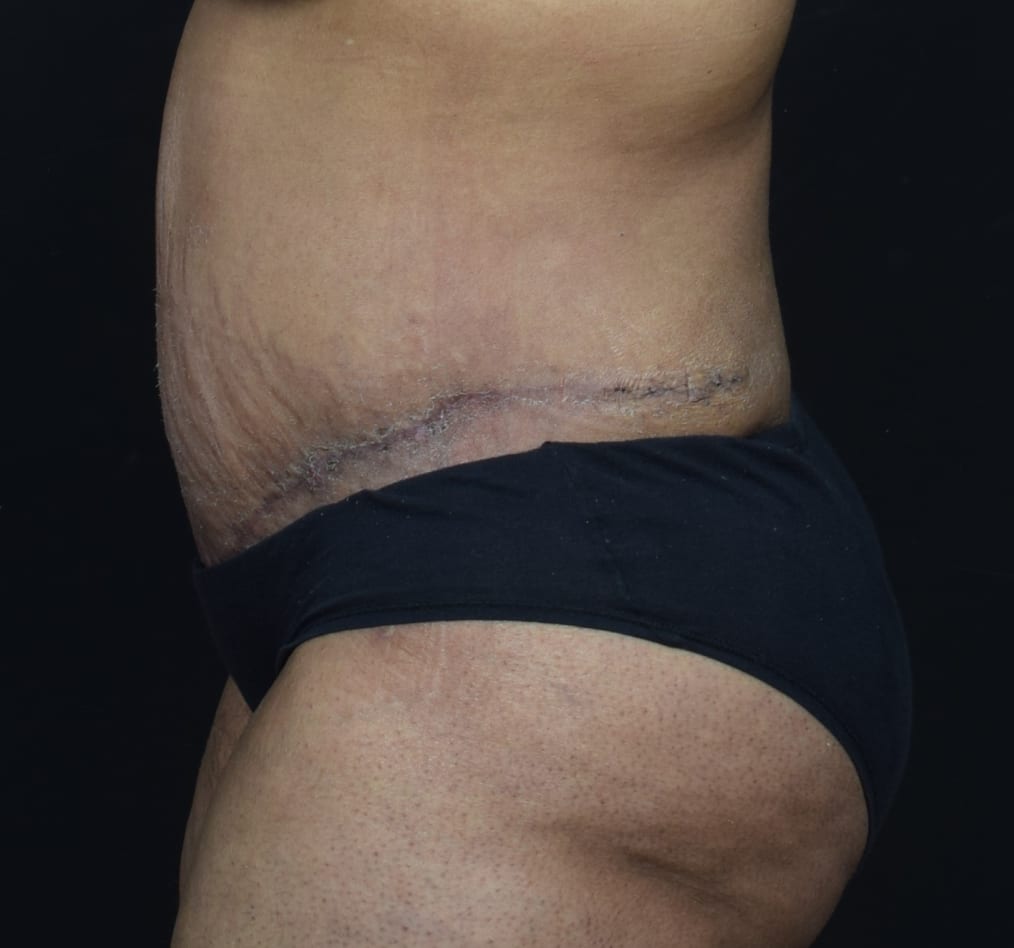 Patient 68 gallery after d