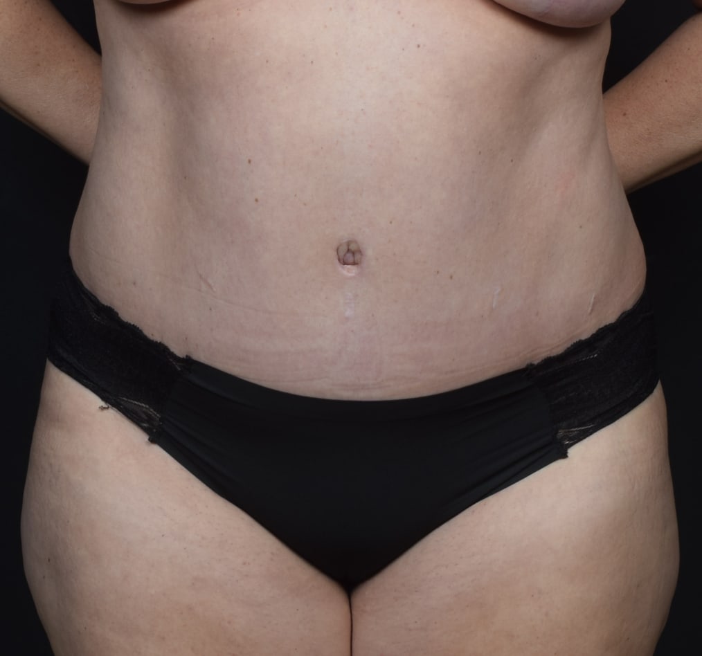 Patient 69 gallery after a