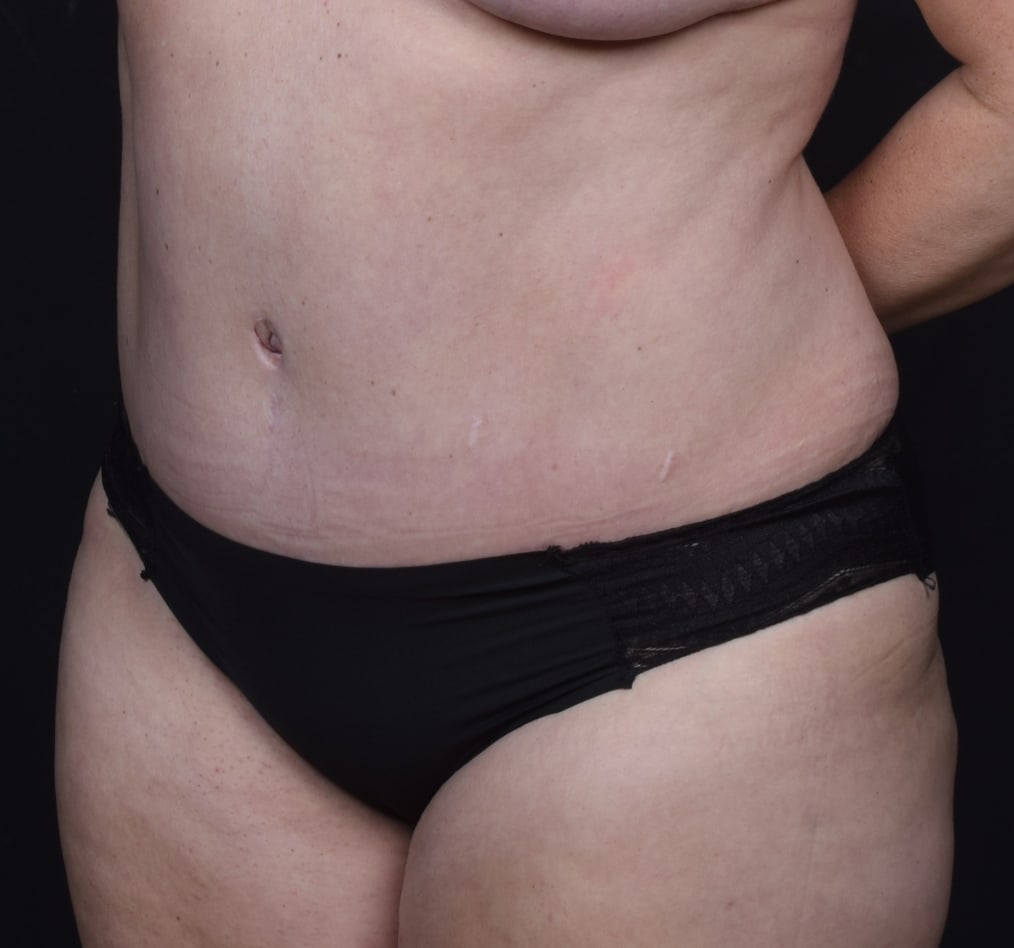 Patient 69 gallery after b