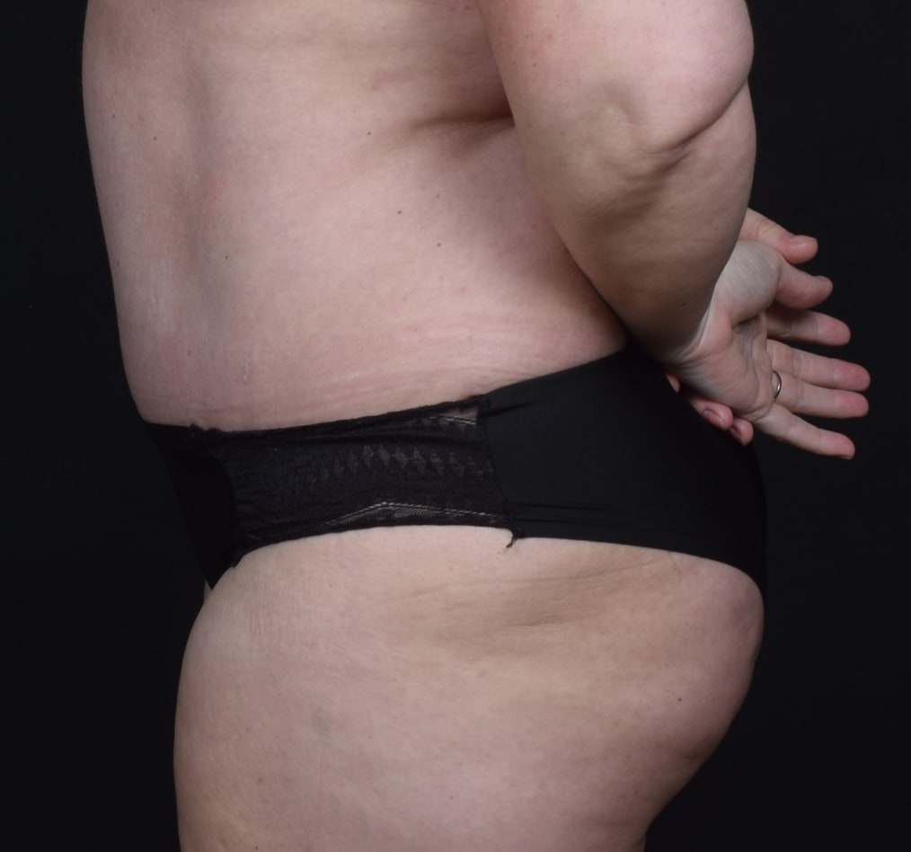 Patient 69 gallery after d