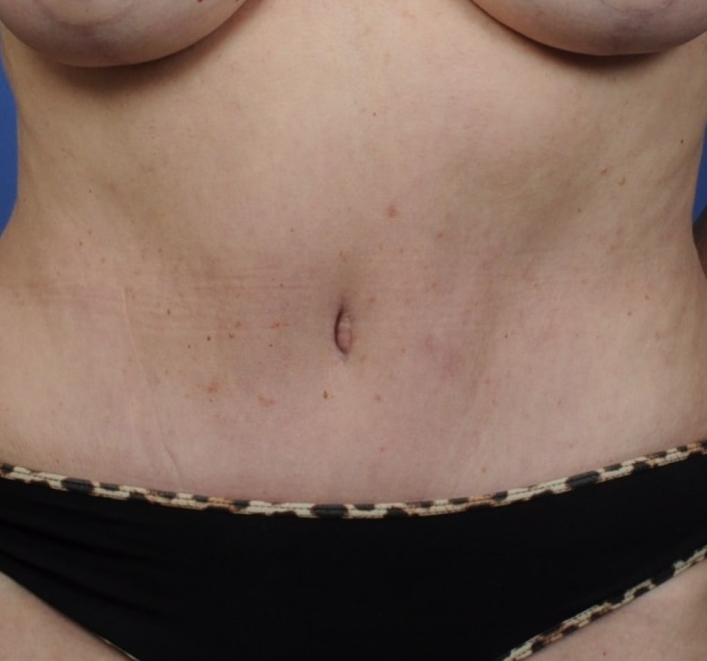 Patient 70 gallery after a