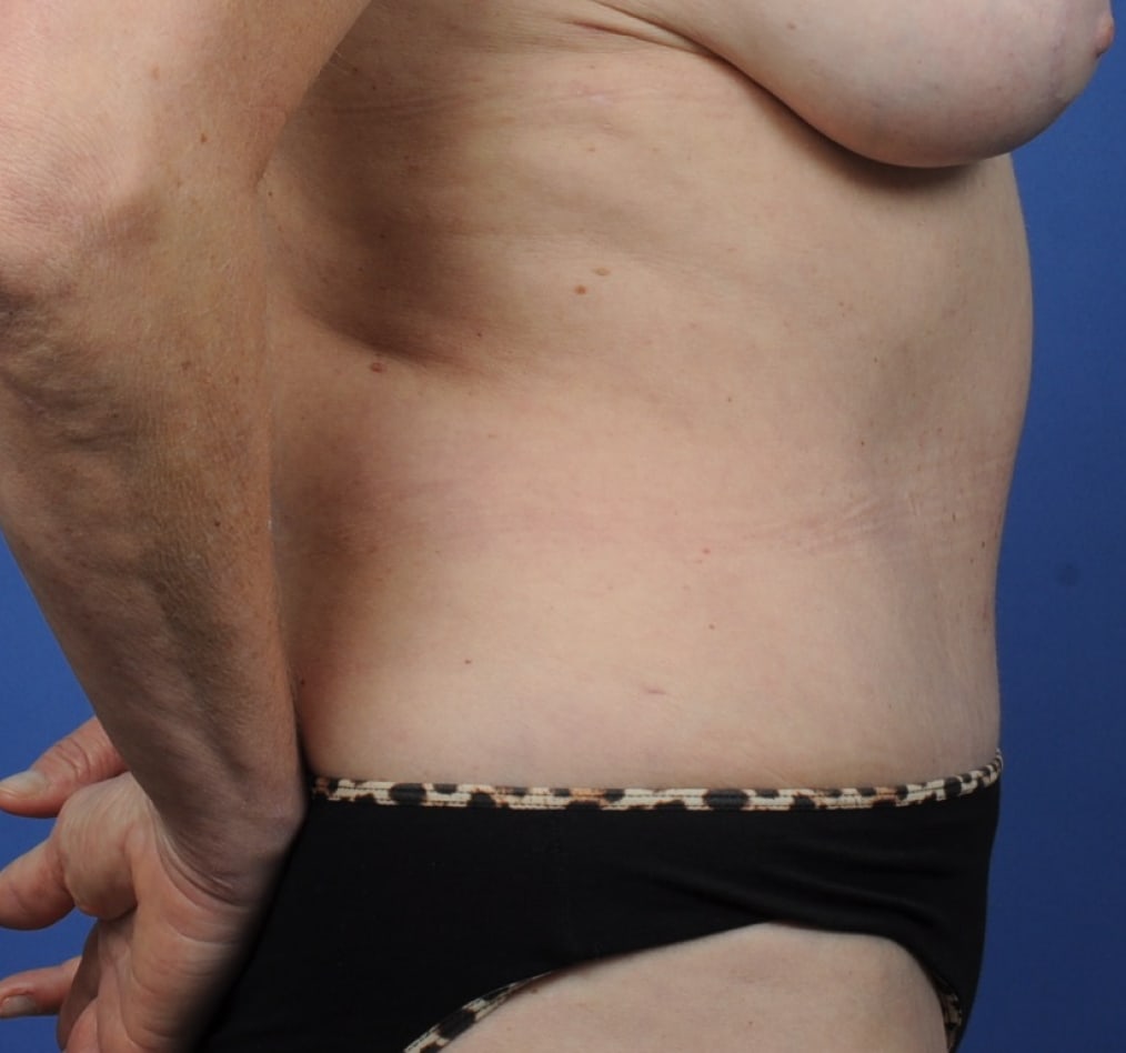 Patient 70 gallery after e