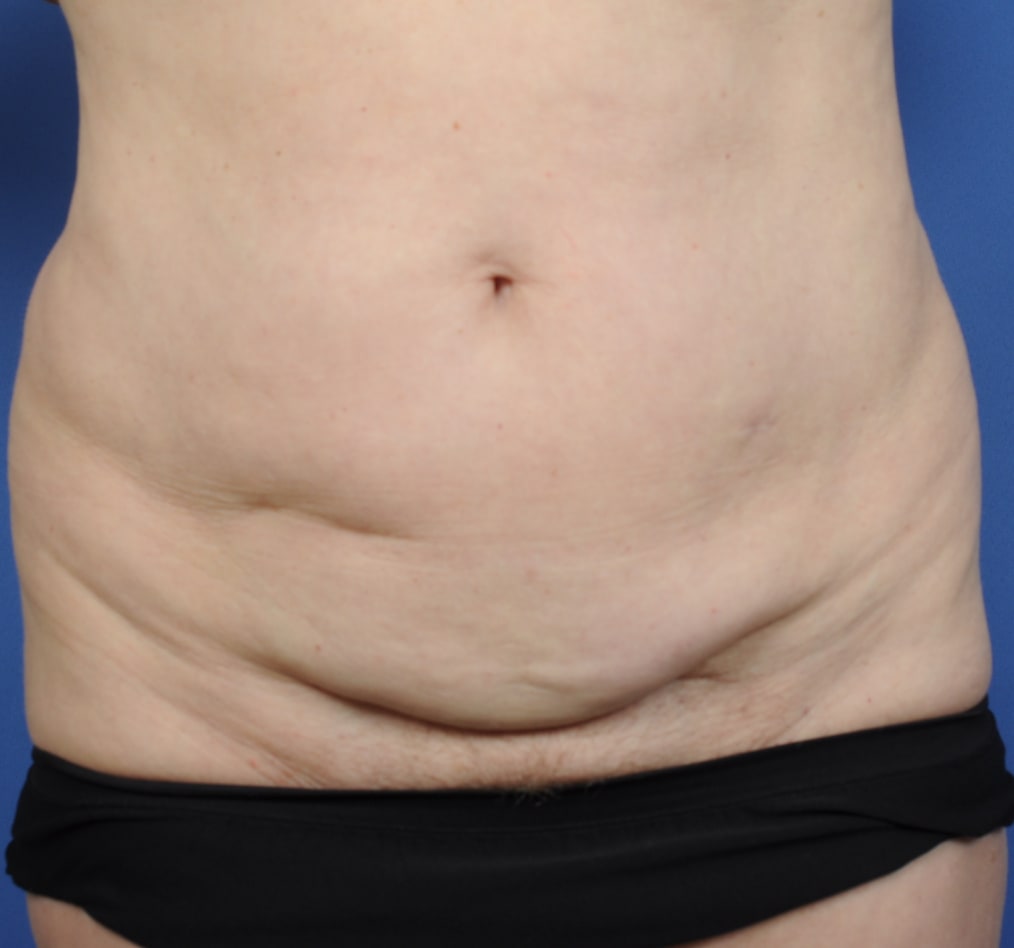 Patient 70 gallery before a