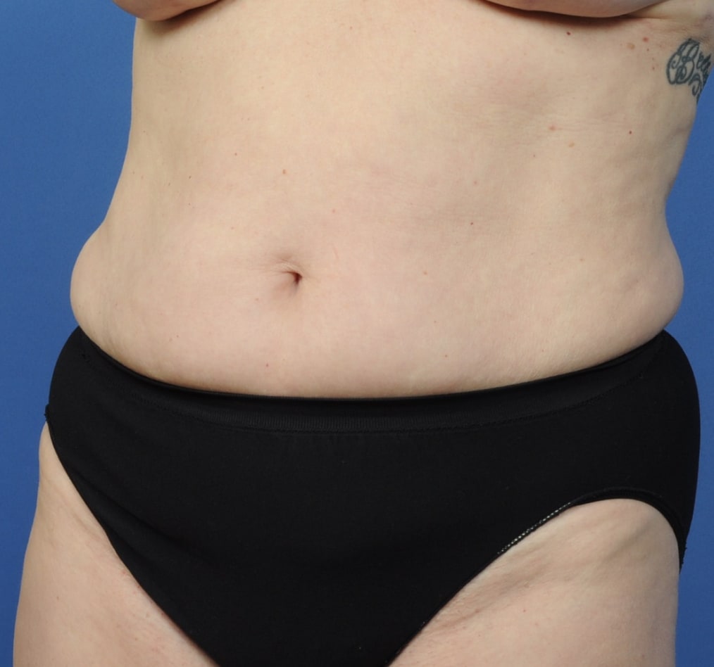 Patient 70 gallery before b