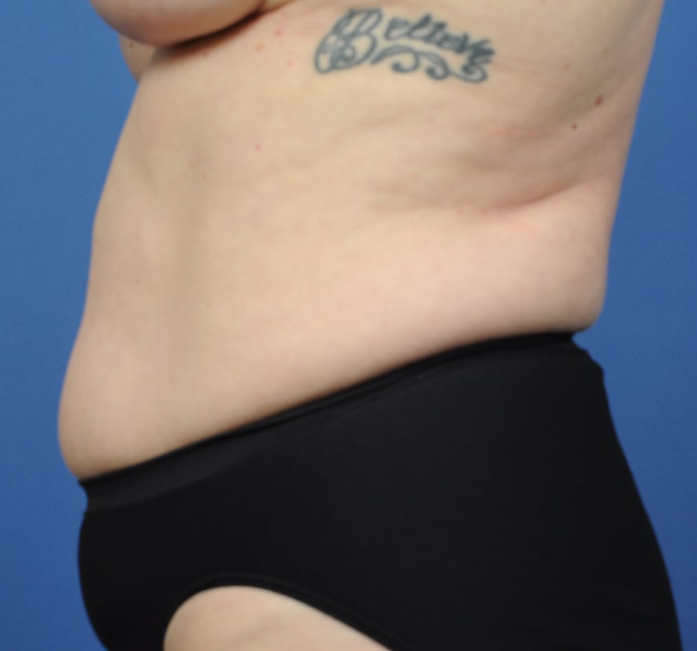 Patient 70 gallery before d