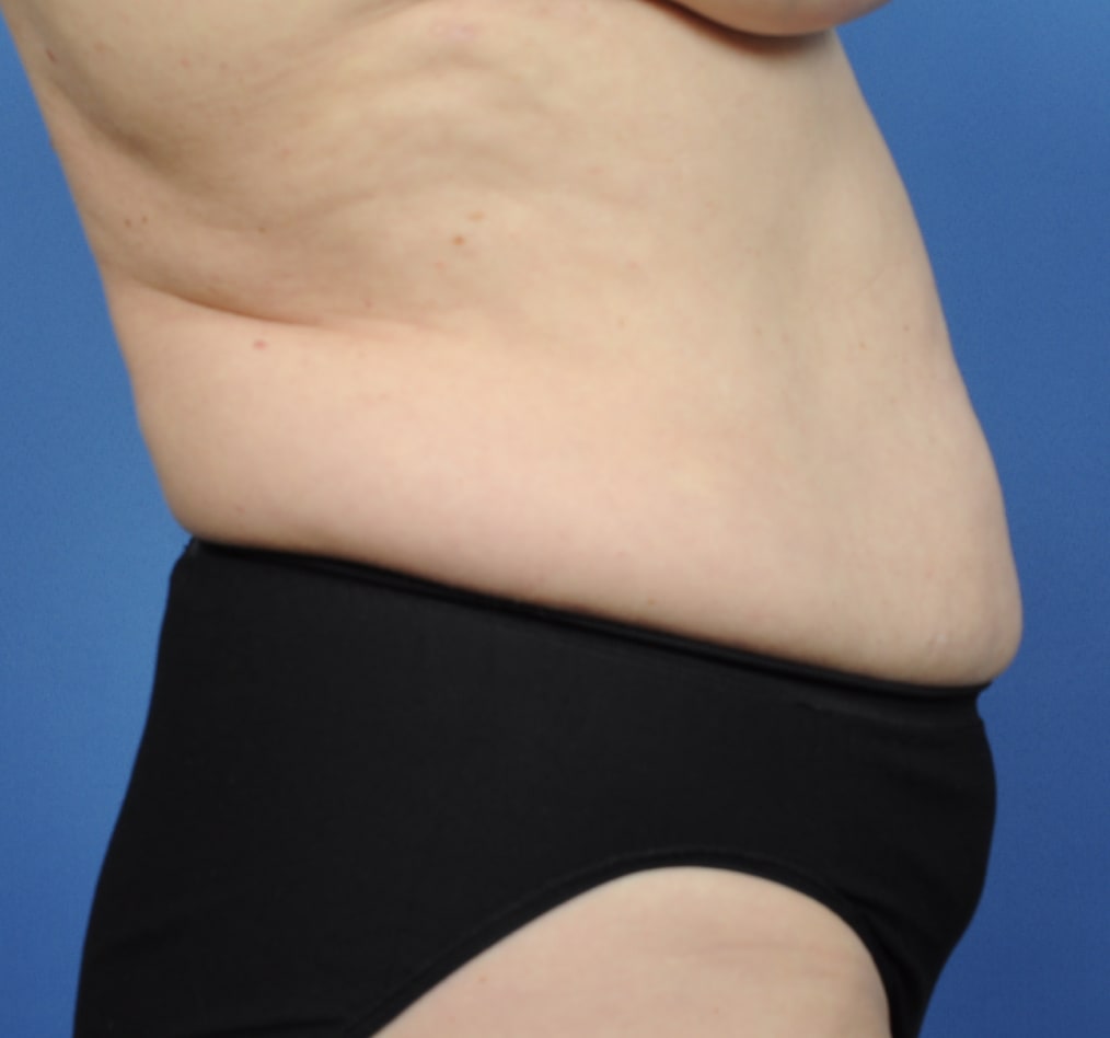 Patient 70 gallery before e