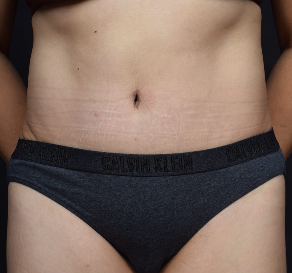 Patient 71 gallery after a